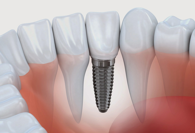 implantes-ossos-integrados