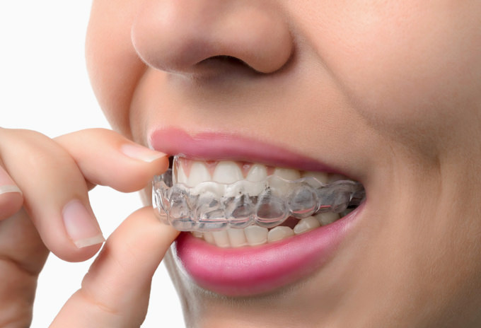 invisalign