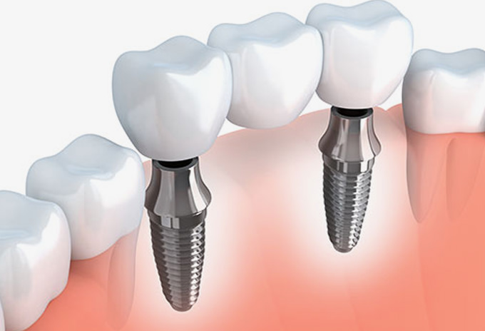 protese-sobre-implantes